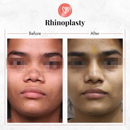 Rhinoplasty